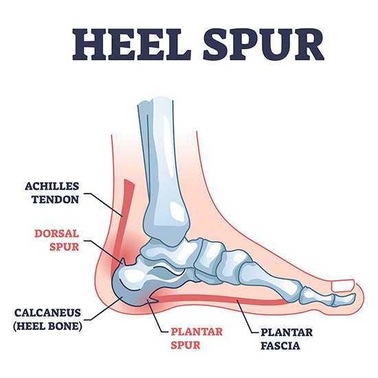 Heel Spurs - Causes and Treatment