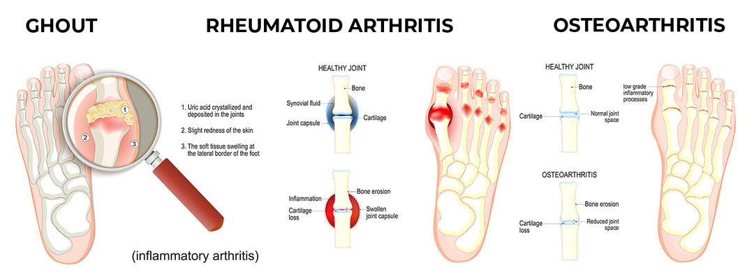 Gout, Rheumatoid arthritis, and Osteoarthritis -- Causes and Treatment