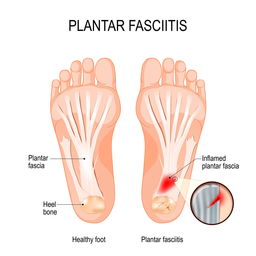 Plantar Fasciitis - Causes and Treatment