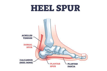 Heel Spurs - Causes and Treatment
