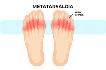Metatarsalgia